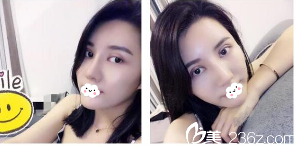 深圳美萊徐占鋒雙眼皮第15天自拍 深圳美萊徐占鋒雙眼皮第15天自拍