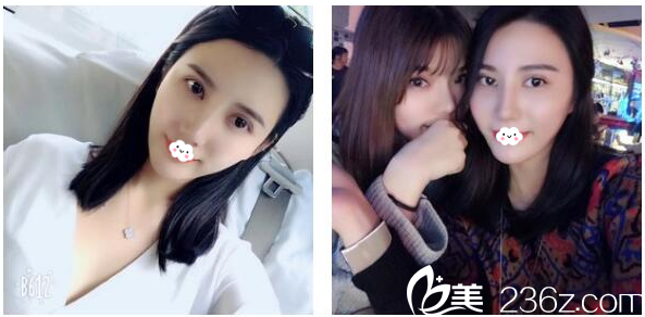 找徐占鋒醫(yī)生割雙眼皮40天恢復情況 找徐占鋒醫(yī)生割雙眼皮40天恢復情況