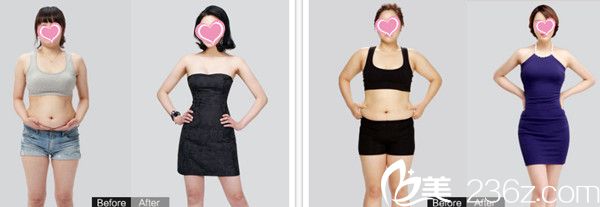 <!--<i data=20240703-sp></i>-->主任吸脂瘦身案例