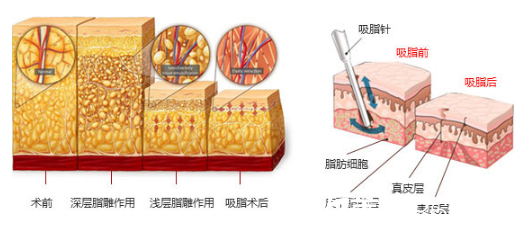 分層吸脂緊膚術(shù)原理