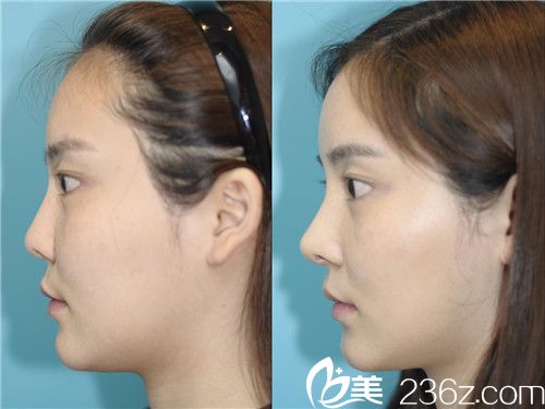 韓國碧夏整形醫(yī)院案例