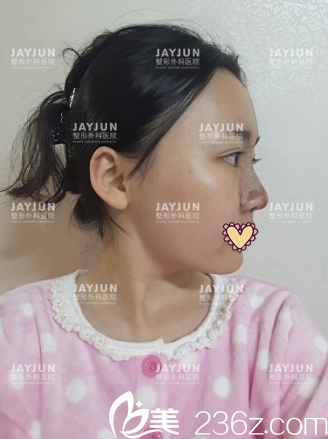 術(shù)后第四天