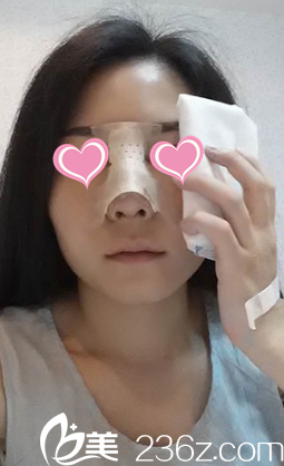 術(shù)后第2天鼻子慢慢恢復(fù)中 術(shù)后第2天鼻子慢慢恢復(fù)中