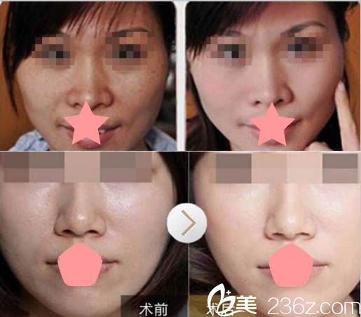 黃富梅激光祛斑和嫩膚美白案例