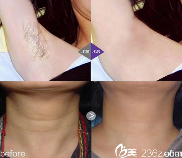 福州臺(tái)江潘桂蘭激光脫毛和祛頸紋案例