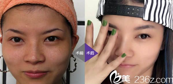 福州臺江許碧珠激光祛斑案例 福州臺江許碧珠激光祛斑案例