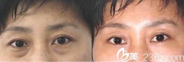 許碧珠黑眼圈前后對比效果 許碧珠黑眼圈前后對比效果