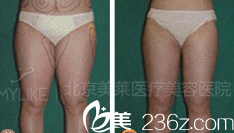 北京美萊醫(yī)療美容醫(yī)院案例 北京美萊醫(yī)療美容醫(yī)院案例