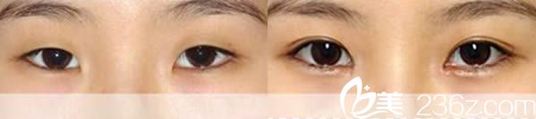 福州臺江整形醫(yī)院雙眼皮案例 福州臺江整形醫(yī)院雙眼皮案例