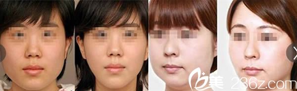 瘦臉前后對比效果 瘦臉前后對比效果