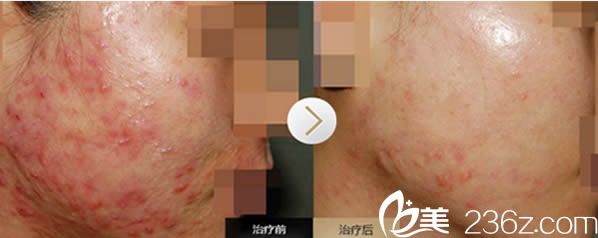 福州臺江祛痘前對比效果 福州臺江祛痘前對比效果