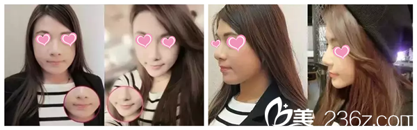 秦秀仙醫(yī)生注射自體脂肪案例 秦秀仙醫(yī)生注射自體脂肪案例