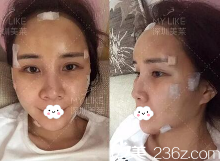 在深圳美萊做完脂肪填充天 在深圳美萊做完脂肪填充天