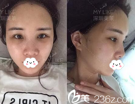 脂肪填充第3天恢復(fù)情況 脂肪填充第3天恢復(fù)情況