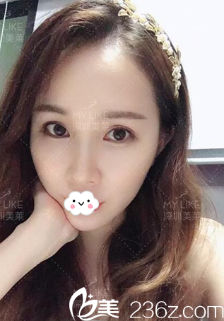 脂肪填充一個(gè)月恢復(fù)情況 脂肪填充一個(gè)月恢復(fù)情況