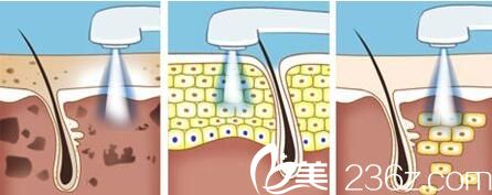 <!--<i data=20240703-sp></i>-->伊萊美<!--<i data=20240703-sp></i>-->講解光子嫩膚2