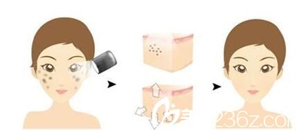 <!--<i data=20240703-sp></i>-->伊萊美<!--<i data=20240703-sp></i>-->講解光子嫩膚