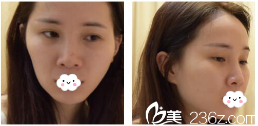 術(shù)前照片 術(shù)前照片