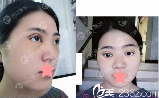 蝴蝶媚眼雙眼皮術(shù)后天的樣子 蝴蝶媚眼雙眼皮術(shù)后天的樣子