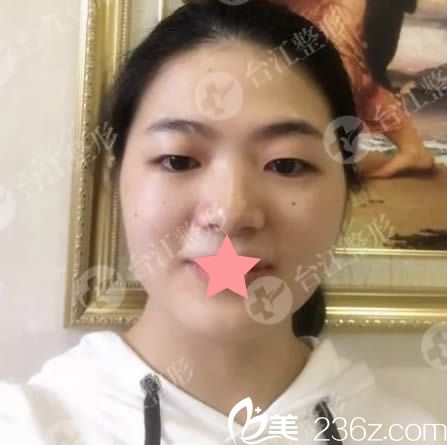 在福州臺(tái)江整形醫(yī)院做雙眼皮術(shù)前照 在福州臺(tái)江整形醫(yī)院做雙眼皮術(shù)前照