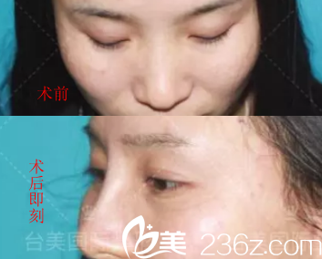 合肥臺(tái)美葉凡隆鼻怎么樣？看隆鼻案例效果