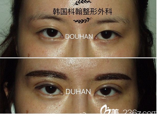 申枓翰院長雙眼皮修復(fù)案例 申枓翰院長雙眼皮修復(fù)案例