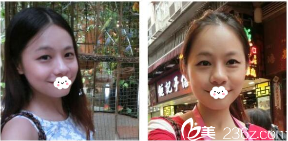 雙眼皮術前游玩照片 雙眼皮術前游玩照片