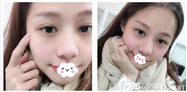 朋友陪我找廣州星團(tuán)（原博美）吳偉航醫(yī)生做了切開(kāi)雙眼皮和開(kāi)眼角