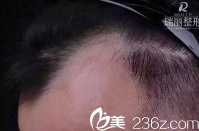 黑龍江瑞麗植發(fā)案例 黑龍江瑞麗植發(fā)案例