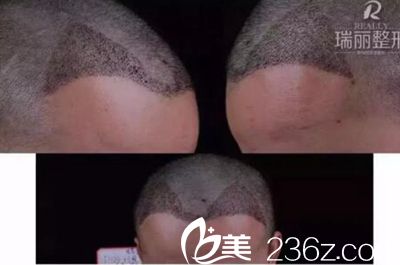 瑞麗植發(fā)術(shù)后第10天 瑞麗植發(fā)術(shù)后第10天