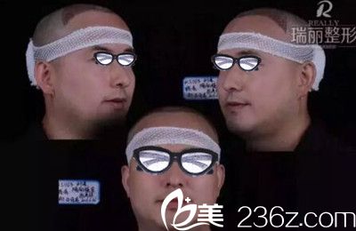 瑞麗植發(fā)術(shù)后即刻效果 瑞麗植發(fā)術(shù)后即刻效果