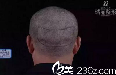 瑞麗植發(fā)取發(fā)區(qū)劃線(xiàn) 瑞麗植發(fā)取發(fā)區(qū)劃線(xiàn)