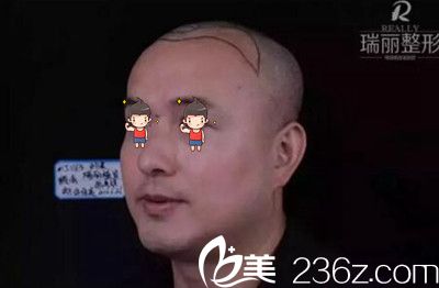 瑞麗植發(fā)術(shù)前左側(cè)頭部劃線(xiàn) 瑞麗植發(fā)術(shù)前左側(cè)頭部劃線(xiàn)