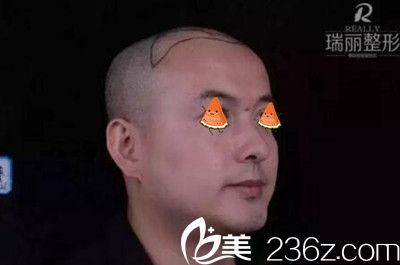 瑞麗植發(fā)術(shù)前右側(cè)頭部劃線(xiàn) 瑞麗植發(fā)術(shù)前右側(cè)頭部劃線(xiàn)