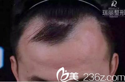 黑龍江瑞麗發(fā)際線(xiàn)種植 黑龍江瑞麗發(fā)際線(xiàn)種植