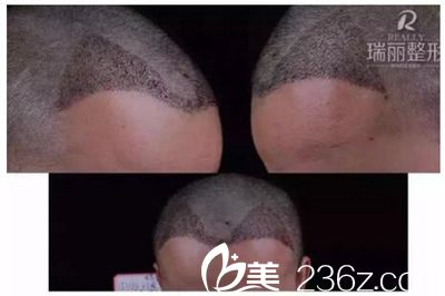 瑞麗植發(fā)術(shù)后第5天 瑞麗植發(fā)術(shù)后第5天