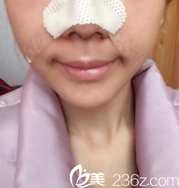 硅膠隆鼻術(shù)后第二天