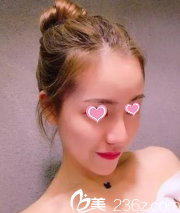 我好稀飯韓國(guó)Delux迪樂(lè)士整形盧相勛給我做的硅膠隆鼻啊