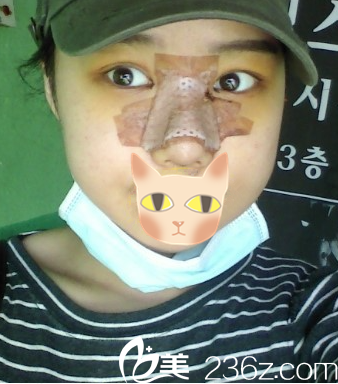 第7天，樸宰熙院長說明天可以拆線了