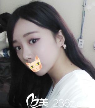 喵~韓國(guó)Motive整形外科我來(lái)做自體軟骨隆鼻+切開(kāi)雙眼皮+瘦臉咯