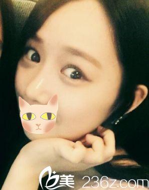 我在韓國Motive整形外科做完的效果