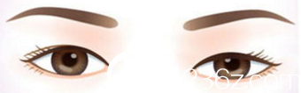 雙眼皮效果