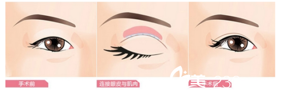 雙眼皮手術(shù)效果