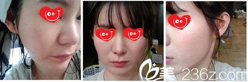 去痘坑兩月效果、