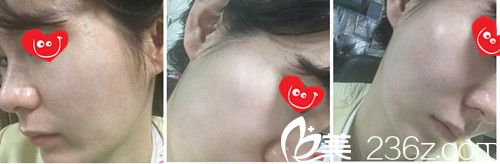 祛除痘印75天效果