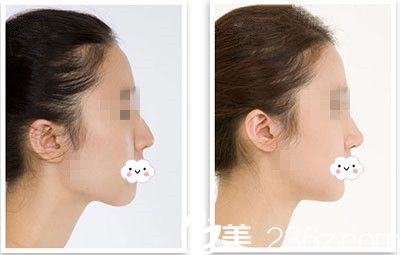 隆鼻手術(shù)原理