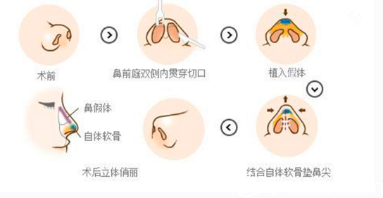 加耳軟骨墊鼻尖的復(fù)合假體隆鼻