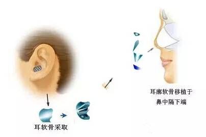 自體軟骨移植為核心的鼻綜合