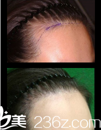 喬顏思經(jīng)典毛發(fā)移植案例