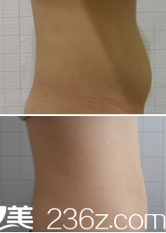 喬顏思減肥案例前后對(duì)比